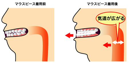 マウスピース着用図